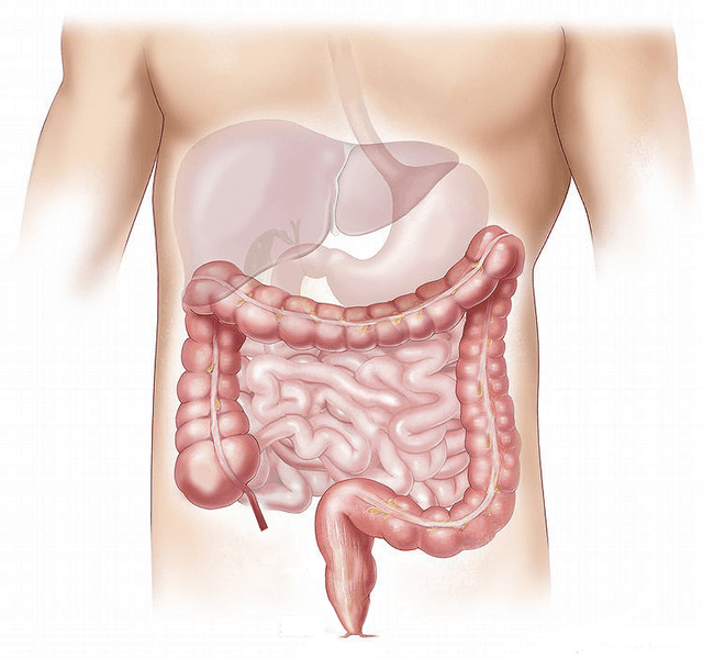 Illustration of inflamed intestinal segments