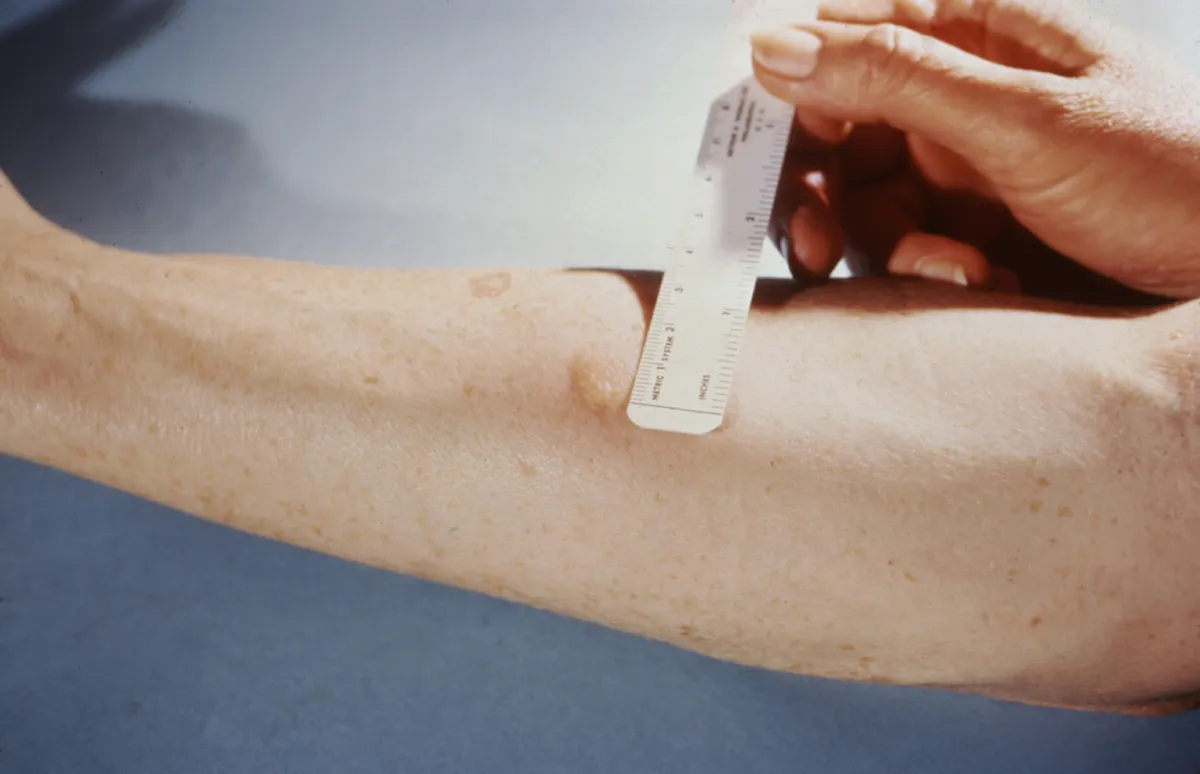 Tests et évaluation d'allergie avec un clinicien