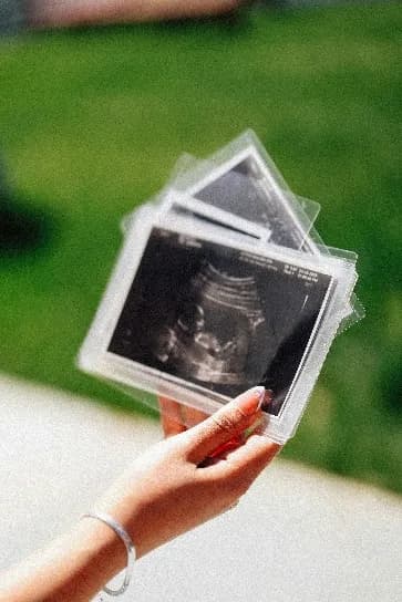 Prenatal ultrasound