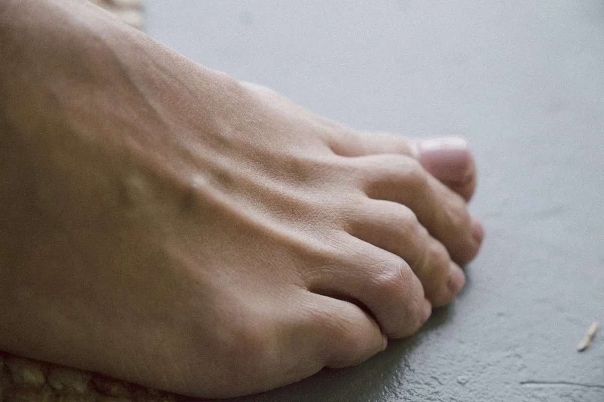 Gout & Nutrition: A Clinical Overview