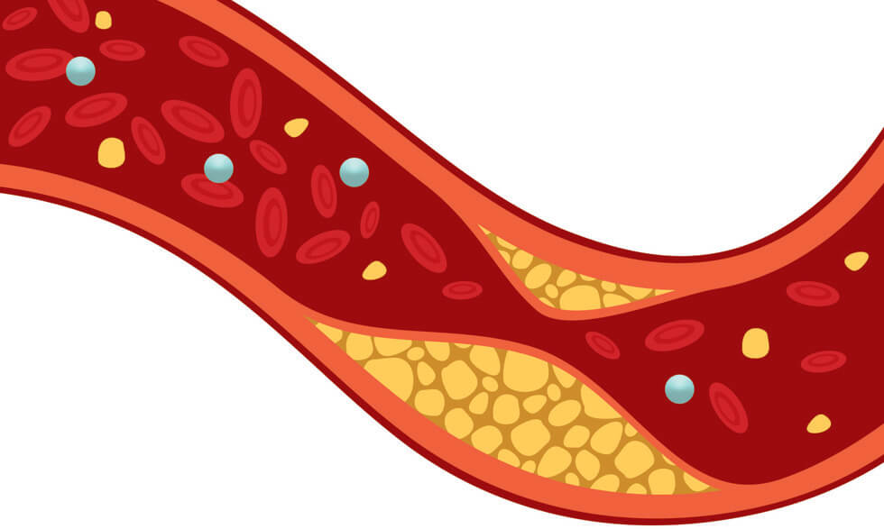 High Cholesterol